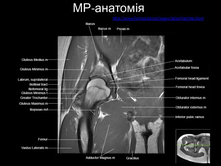 МР-анатомія http://www.freitasrad.net/pages/atlas/Hip/Hip.html