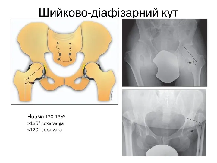 Шийково-діафізарний кут Норма 120-135о >135o coxa valga