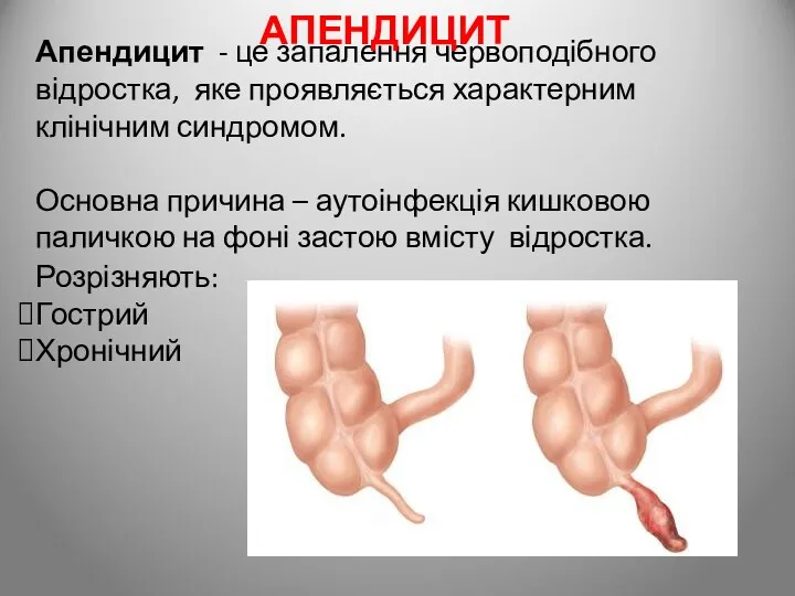 Апендицит - це запалення червоподібного відростка, яке проявляється характерним клінічним