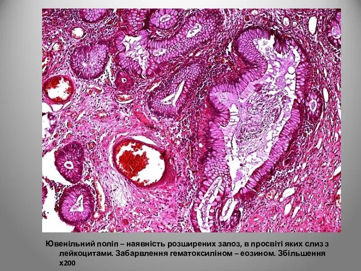 Ювенільний поліп – наявність розширених залоз, в просвіті яких слиз