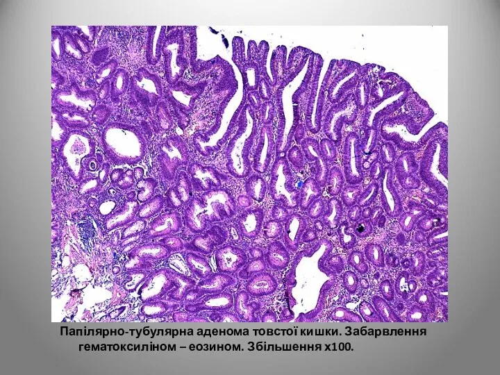 Папілярно-тубулярна аденома товстої кишки. Забарвлення гематоксиліном – еозином. Збільшення х100.