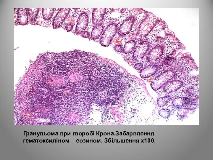 Гранульома при гворобі Крона.Забарвлення гематоксиліном – еозином. Збільшення х100.