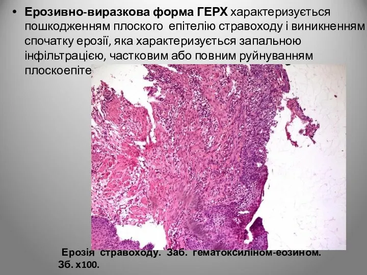 Ерозивно-виразкова форма ГЕРХ характеризується пошкодженням плоского епітелію стравоходу і виникненням