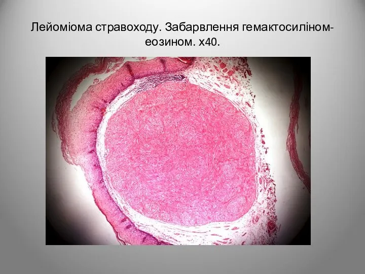Лейоміома стравоходу. Забарвлення гемактосиліном-еозином. х40.