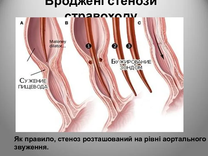 Вроджені стенози стравоходу Як правило, стеноз розташований на рівні аортального звуження.