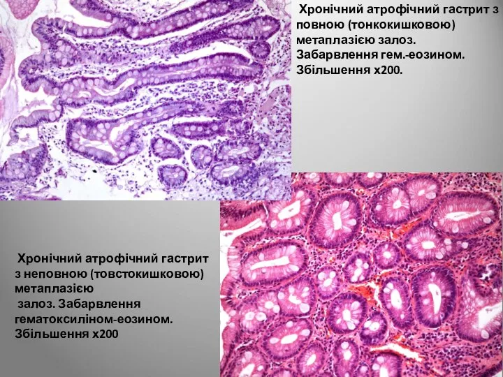 Хронічний атрофічний гастрит з повною (тонкокишковою) метаплазією залоз. Забарвлення гем.-еозином.