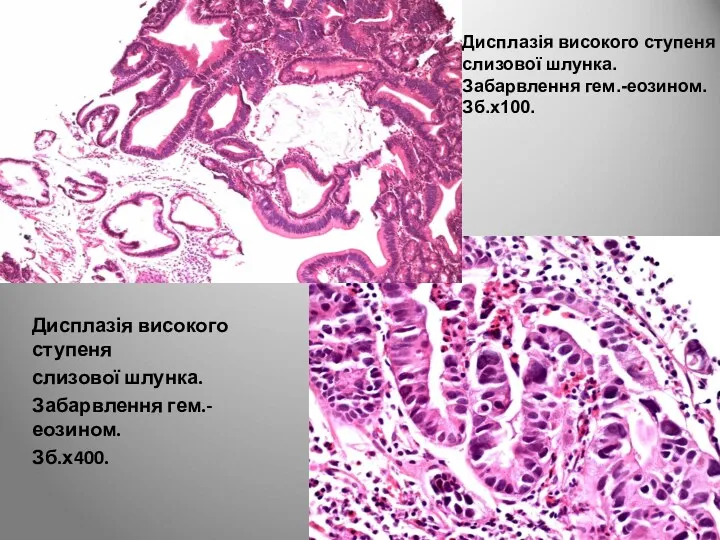 Дисплазія високого ступеня слизової шлунка. Забарвлення гем.-еозином. Зб.х400. Дисплазія високого ступеня слизової шлунка. Забарвлення гем.-еозином. Зб.х100.