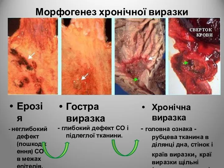 Ерозія - неглибокий дефект (пошкодження) СО в межах епітелія. Морфогенез