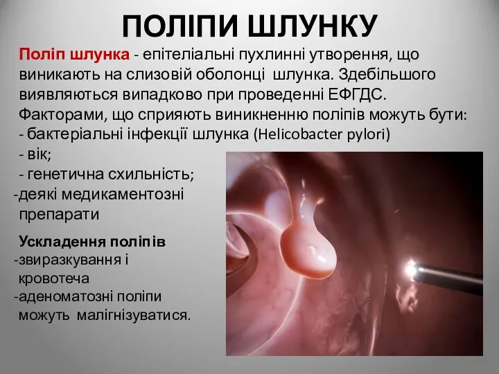 ПОЛІПИ ШЛУНКУ Поліп шлунка - епітеліальні пухлинні утворення, що виникають