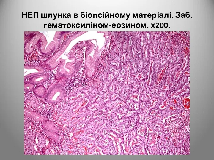 НЕП шлунка в біопсійному матеріалі. Заб. гематоксиліном-еозином. х200.