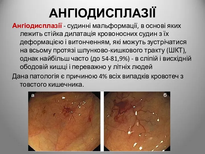 АНГІОДИСПЛАЗІЇ Ангіодисплазії - судинні мальформації, в основі яких лежить стійка