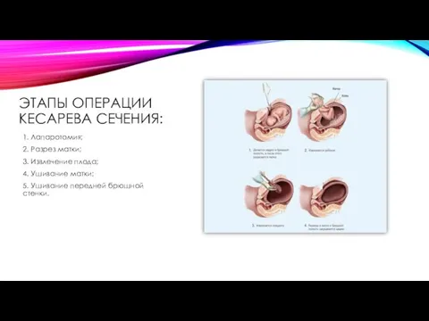 ЭТАПЫ ОПЕРАЦИИ КЕСАРЕВА СЕЧЕНИЯ: 1. Лапаротомия; 2. Разрез матки; 3.