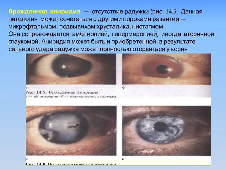 Врожденная аниридия — отсутст­вие радужки (рис. 14.5. Данная патология может