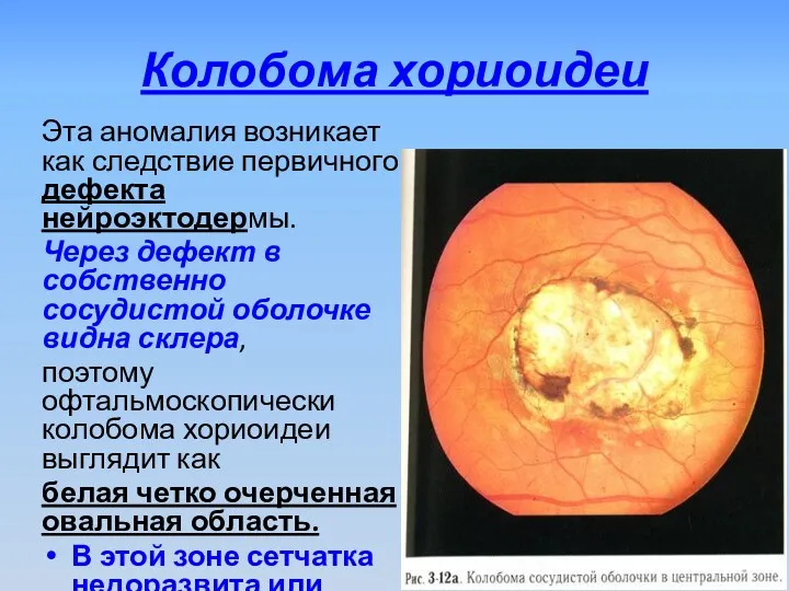 Колобома хориоидеи Эта аномалия возникает как следствие первичного дефекта нейроэктодермы.