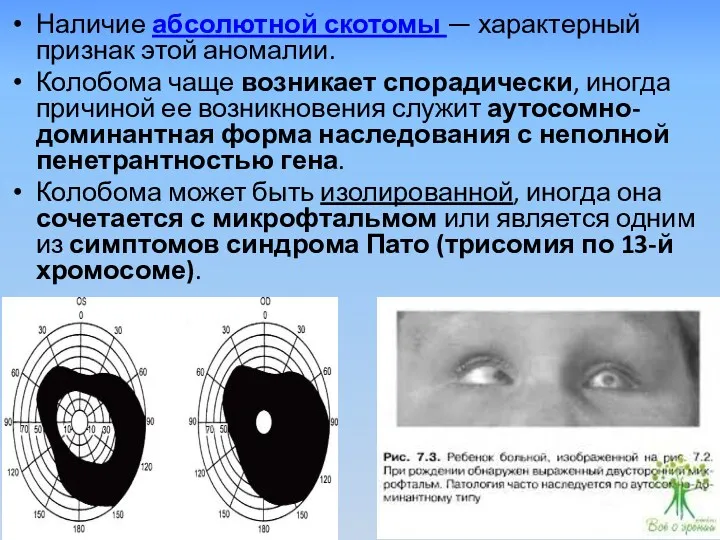 Наличие абсолютной скотомы — характерный признак этой аномалии. Колобома чаще