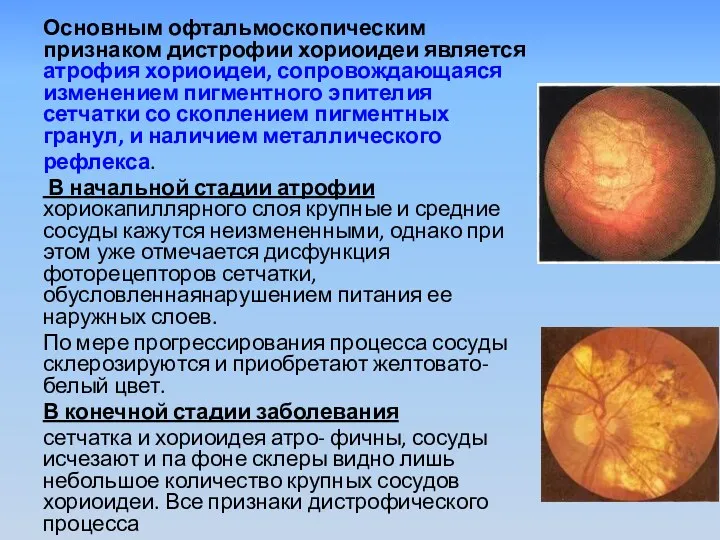 Основным офтальмоскопическим признаком дистрофии хориоидеи является атрофия хориоидеи, сопровождающаяся изменением