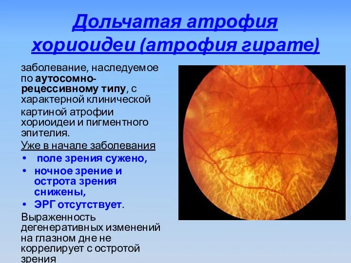 Дольчатая атрофия хориоидеи (атрофия гирате) заболевание, наследуемое по аутосомно-рецессивному типу,