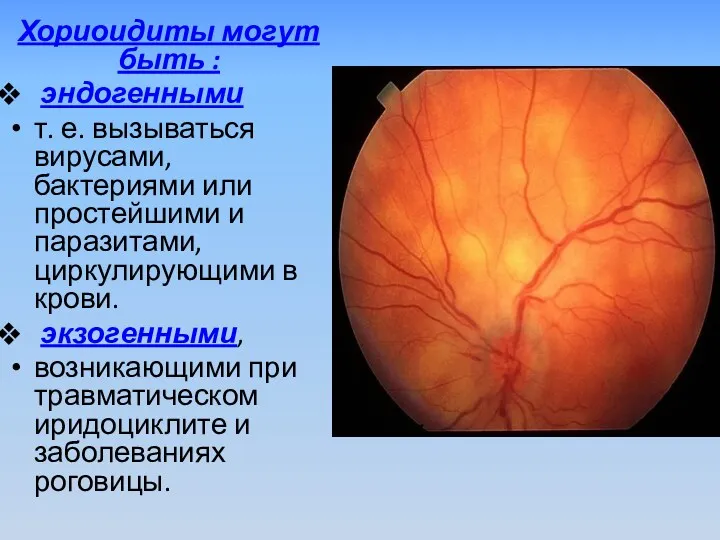 Хориоидиты могут быть : эндогенными т. е. вызываться вирусами, бактериями