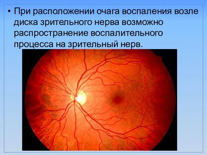 При расположении очага воспаления возле диска зрительного нерва возможно распространение воспалительного процесса на зрительный нерв.