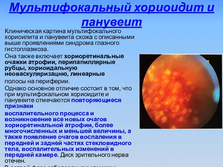 Мультифокальный хориоидит и панувеит Клиническая картина мультифокального хориоилита и панувеита