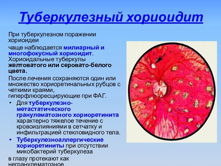 Туберкулезный хориоидит При туберкулезном поражении хориоидеи чаще наблюдается милиарный и