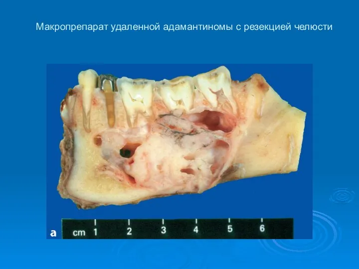 Макропрепарат удаленной адамантиномы с резекцией челюсти