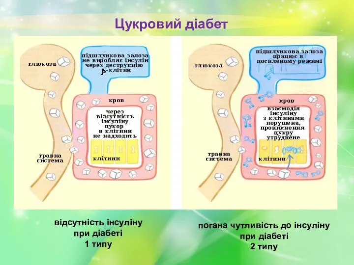 Цукровий діабет відсутність інсуліну при діабеті 1 типу погана чутливість до інсуліну при діабеті 2 типу