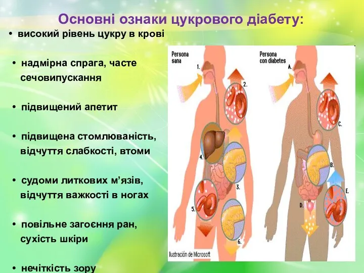 Основні ознаки цукрового діабету: високий рівень цукру в крові •