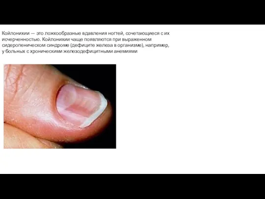 Койлонихии — это ложкообразные вдавления ног­тей, сочетающиеся с их исчерченностью. Койлонихии чаще появляются