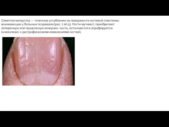 Симптом наперстка — точечные углубления на поверхности ногтевой пластинки, возникающие у больных псориазом