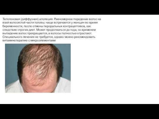Телогеновая (диффузная) алопеция. Равномерное поредение волос на всей волосистой части головы; чаще встречается