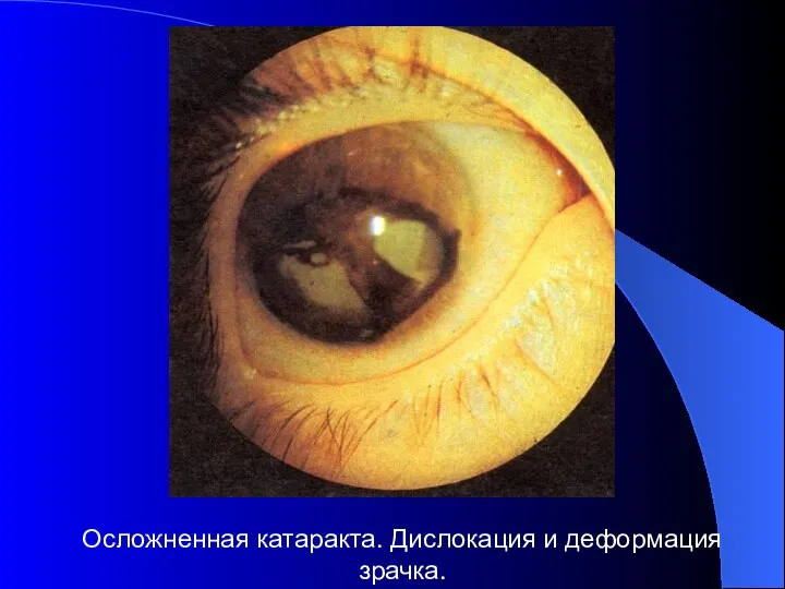 Осложненная катаракта. Дислокация и деформация зрачка.