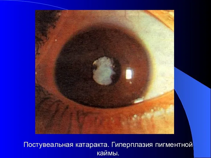 Постувеальная катаракта. Гиперплазия пигментной каймы.