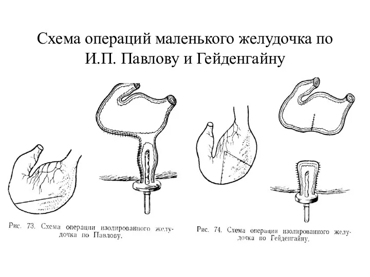 Схема операций маленького желудочка по И.П. Павлову и Гейденгайну