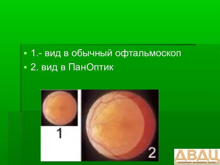 1.- вид в обычный офтальмоскоп 2. вид в ПанОптик