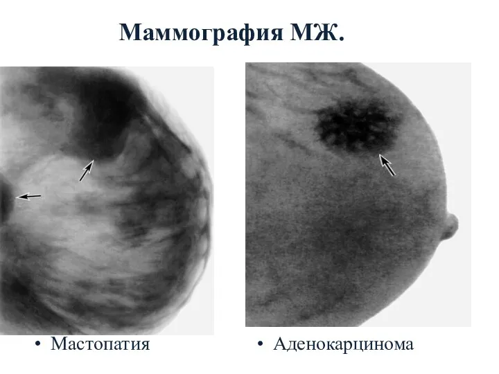 Маммография МЖ. Мастопатия Аденокарцинома