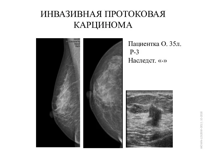 ИНВАЗИВНАЯ ПРОТОКОВАЯ КАРЦИНОМА Пациентка О. 35л. Р-3 Наследст. «-»