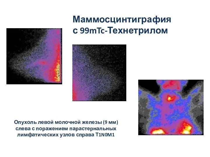 Маммосцинтиграфия с 99mTc-Технетрилом Sinist. lateral Dext. lateral Anterior Опухоль левой
