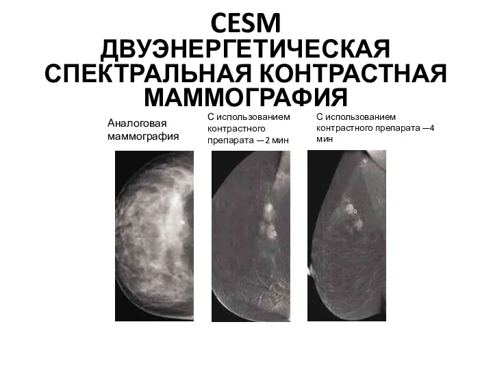 С использованием контрастного препарата —2 мин Аналоговая маммография С использованием