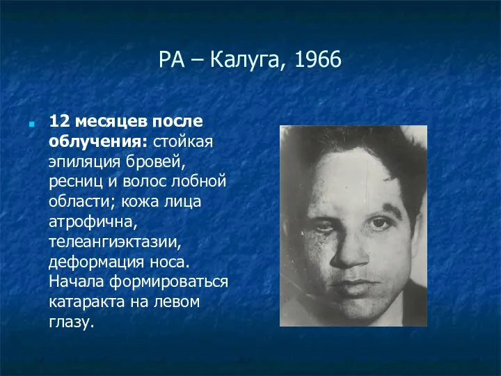 РА – Калуга, 1966 12 месяцев после облучения: стойкая эпиляция бровей, ресниц и