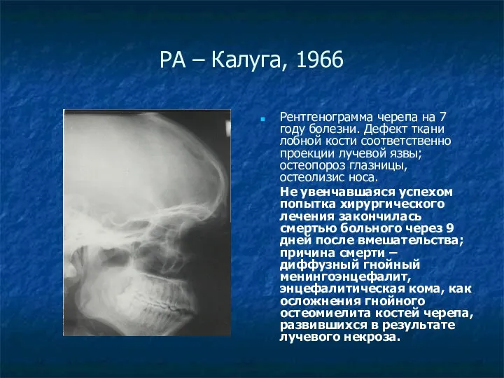 РА – Калуга, 1966 Рентгенограмма черепа на 7 году болезни. Дефект ткани лобной