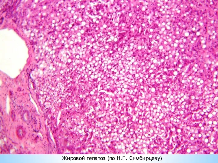 Жировой гепатоз (по Н.П. Симбирцеву)