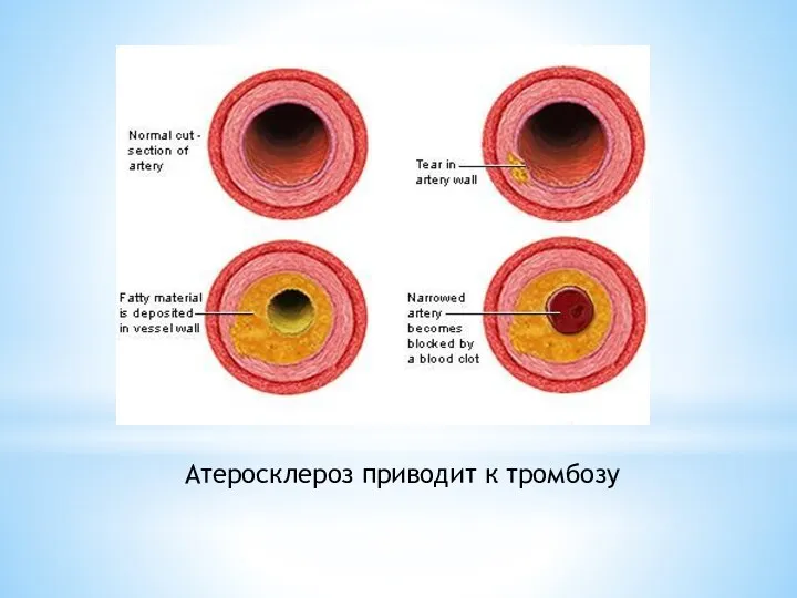 Атеросклероз приводит к тромбозу