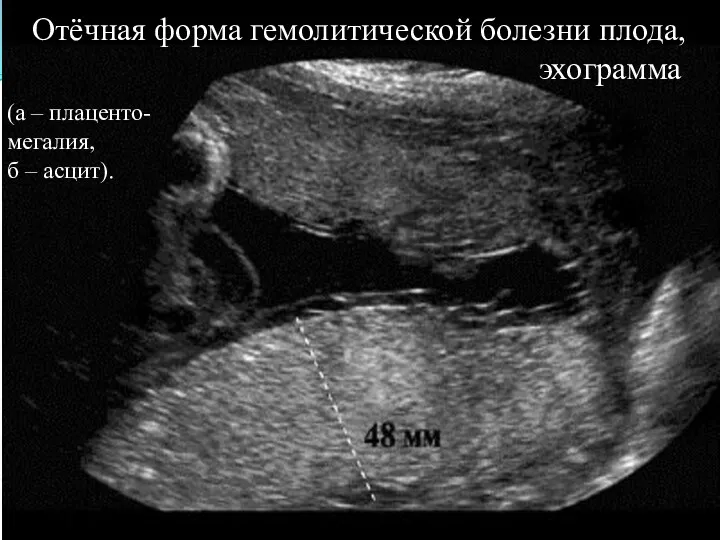 Отёчная форма гемолитической болезни плода, эхограмма (а – плаценто-мегалия, б – асцит).