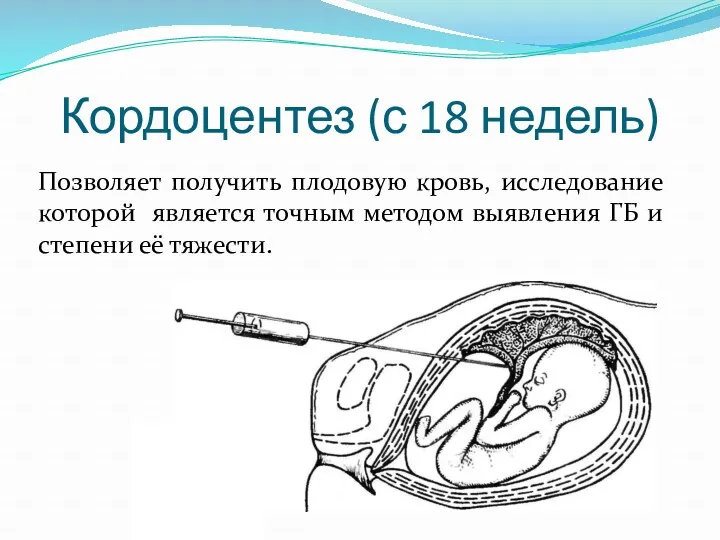 Кордоцентез (с 18 недель) Позволяет получить плодовую кровь, исследование которой