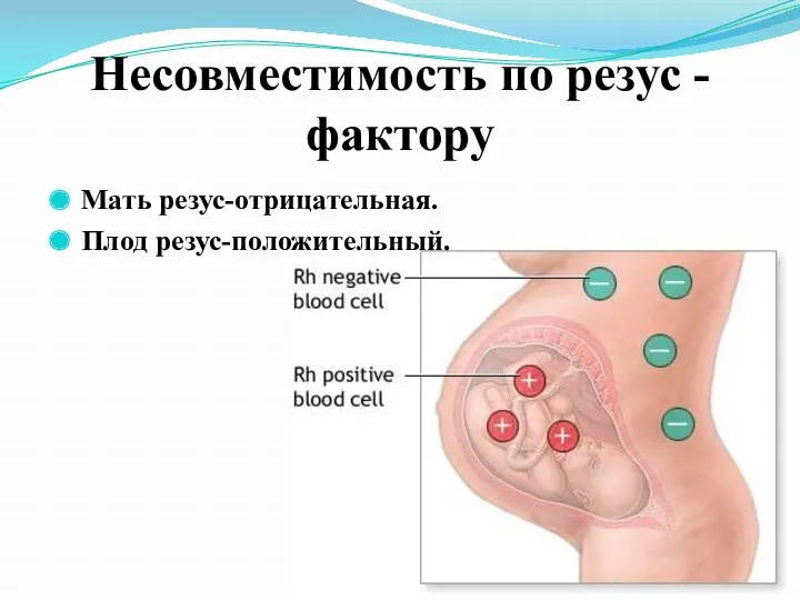 Несовместимость по резус - фактору Мать резус-отрицательная. Плод резус-положительный.