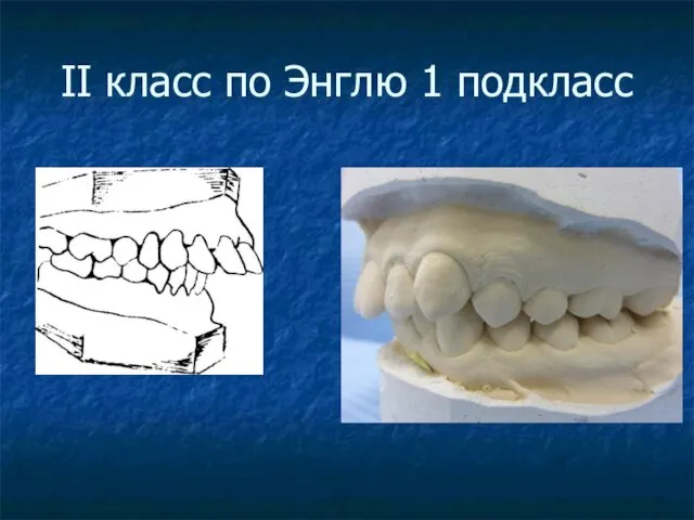 II класс по Энглю 1 подкласс