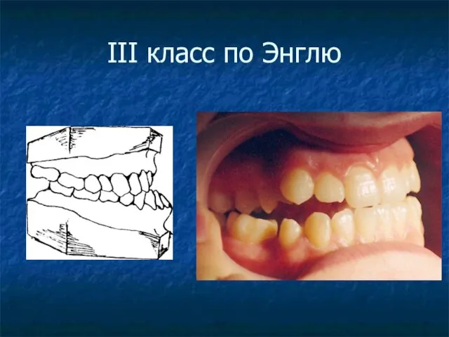 III класс по Энглю