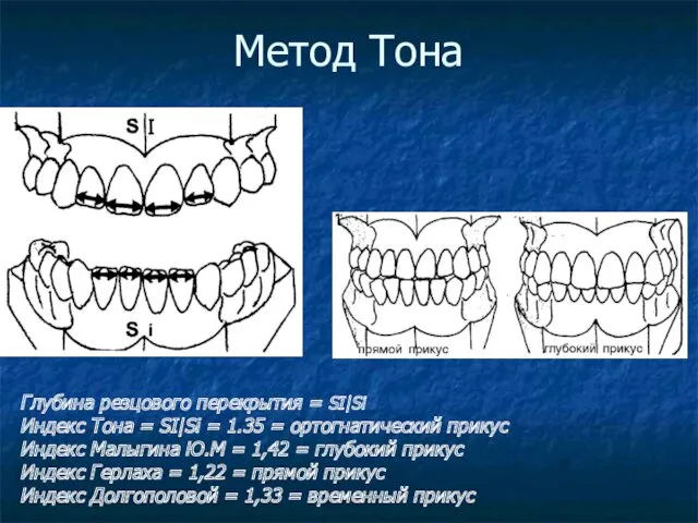 Метод Тона Глубина резцового перекрытия = SI|Si Индекс Тона =