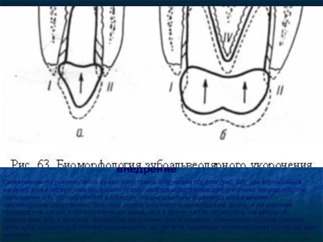 внедрение Схематически погружение зубов можно представить следующим образом (рис. 63):